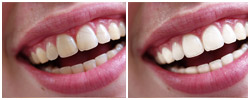 Teeth Whitening Teeth Whitening PS Action